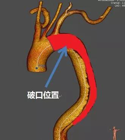 图3 使用castor®分支型支架后近端锚定区延伸，跨过弓部小弯侧，提升密封效果.jpg